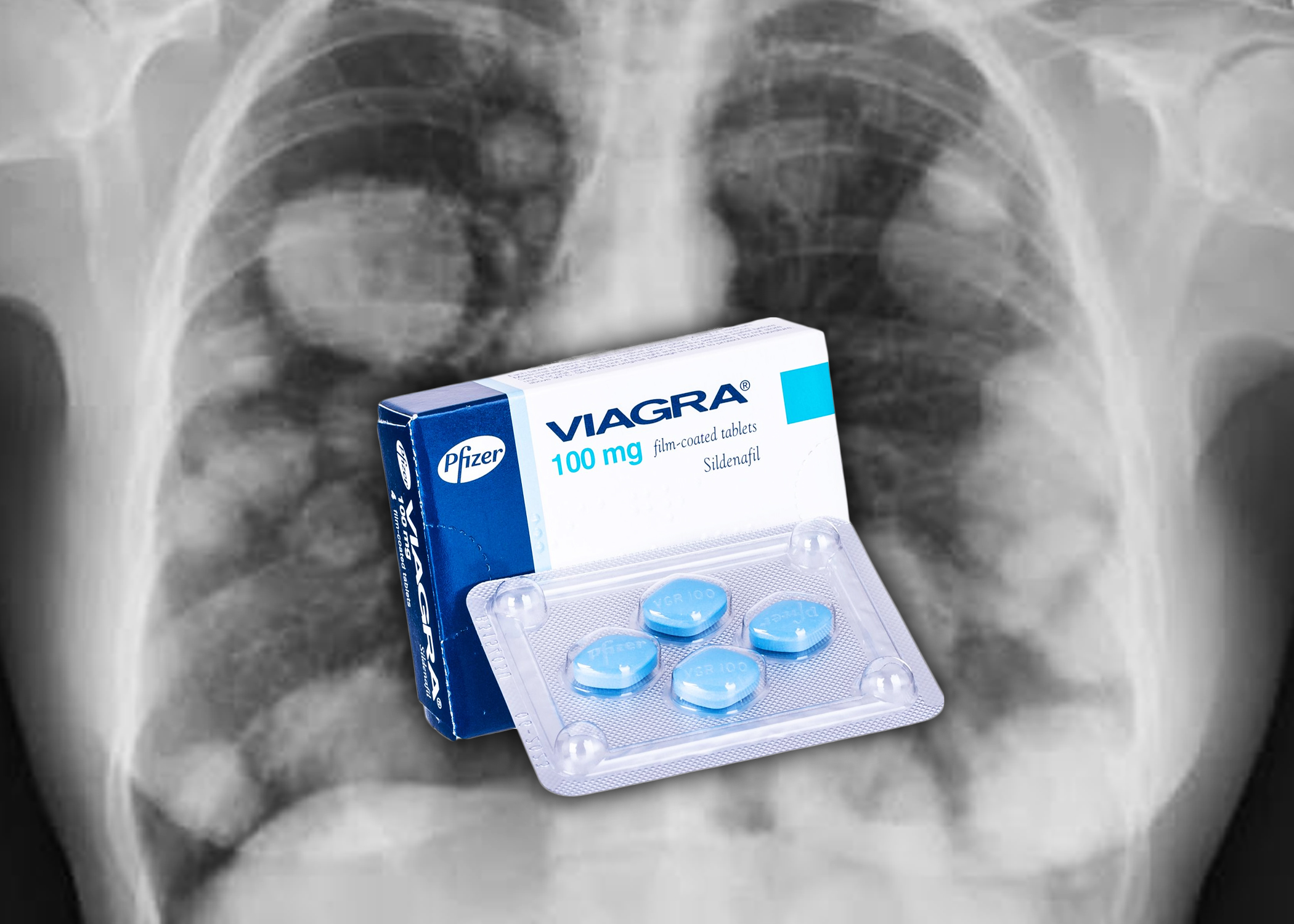 La VIAGRA, el tratamiento de la disfunción eréctil podría servir para frenar el cáncer según nuevo hallazgo científico